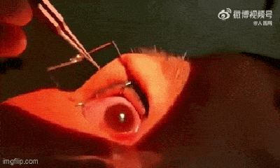 Bác sĩ gắp ra hơn 60 con giun ký sinh trong mắt người phụ nữ